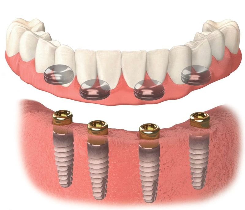 Implant Retained